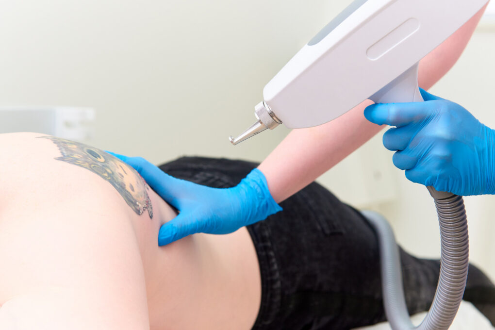 Láser Pico para eliminación de tatuajes