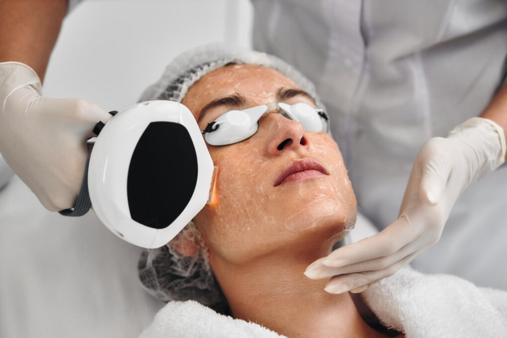 Láser Pico para tratamiento de melasma facial