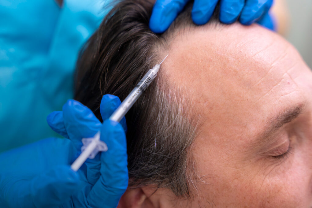 Mesoterapia capilar para fortalecer el cabello